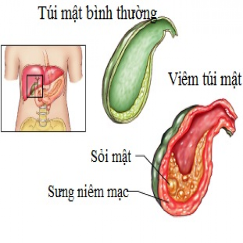 Viêm túi mật cấp là biến chứng hay gặp nhất của sỏi mật